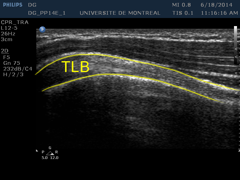 : Tendon du long biceps