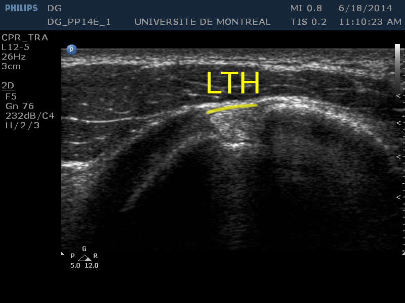 : Ligament transverse huméral