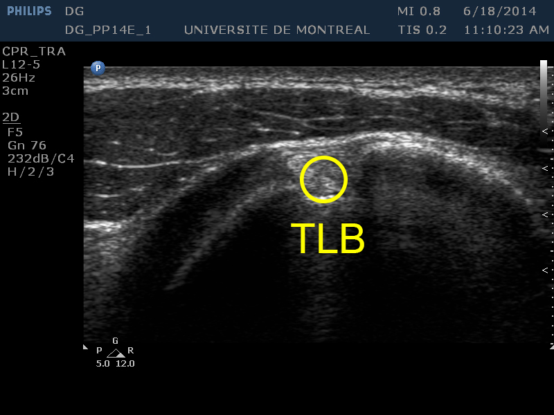: Tendon du long biceps