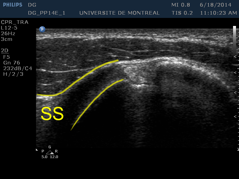 : Tendon du sous-scapulaire