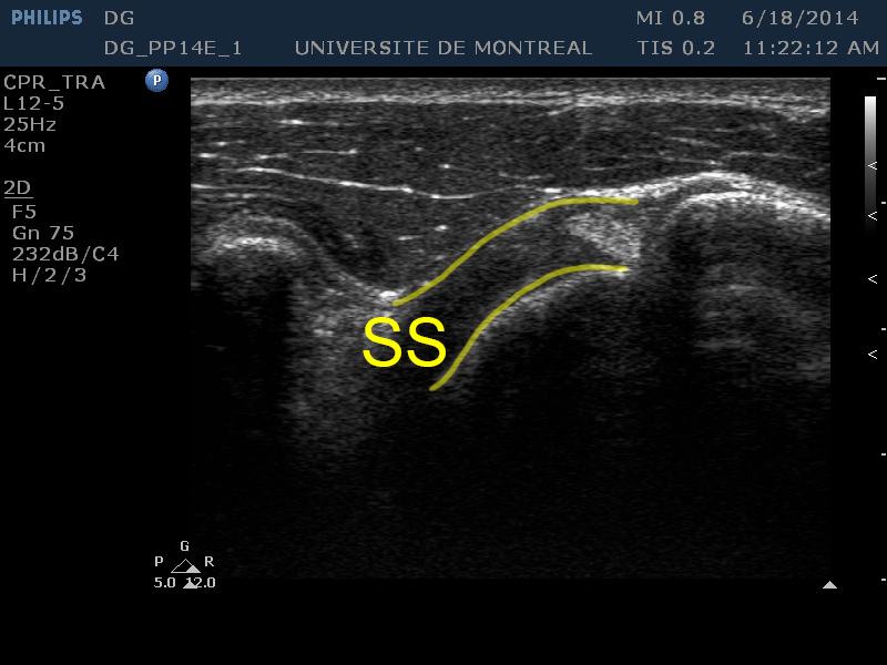 : Tendon du subscapularis